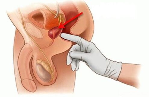 eesnäärme massaaž prostatiidi korral
